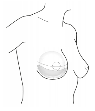 Billede_brystrekonstruktion med implantat og støttevæv.png