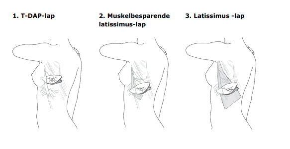 Brystrekonstruktion med væv fra ryggen.png