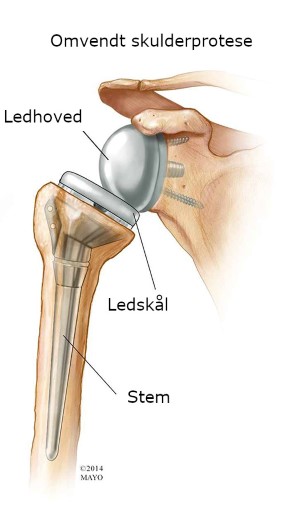 Genoptræning omvendt skulderprotese operation (Deltaprotese) - Universitetshospital