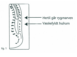 Fig 1 Lumbalpunktur.PNG