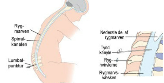 lumbalpunktur.png
