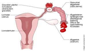 Graviditet uden for livmoderen - stregtegning.jpg