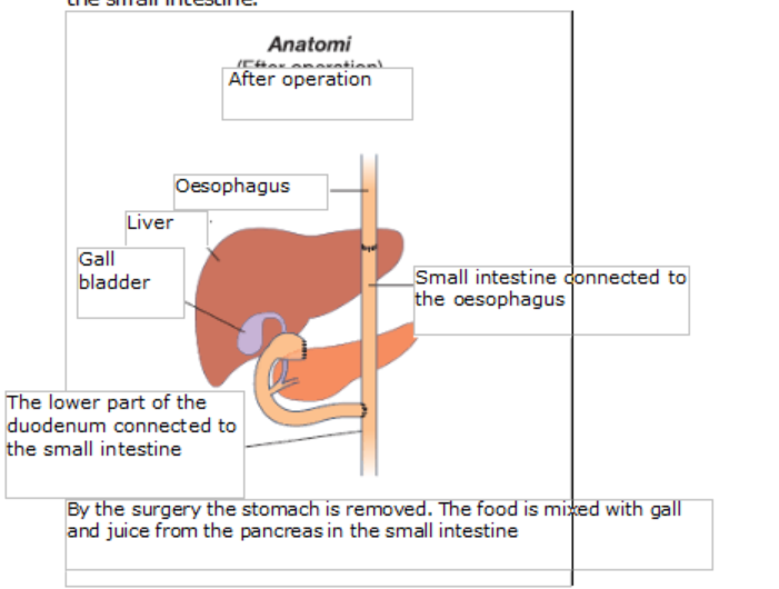 Nutrition after removal of the stomach (total gastrectomi).png