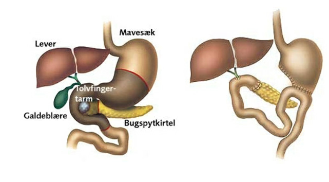 Kræft i bugspytkirtlen, pjece fra Kræf. Bekæmp..png