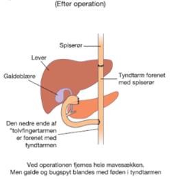 kræft mavesæk.jpg