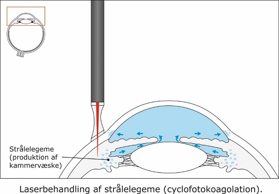 1-laserbehandling for glaukom - cyclo.jpg