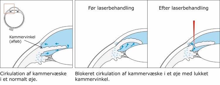 2-laserbehandling for glaukom irido.jpg