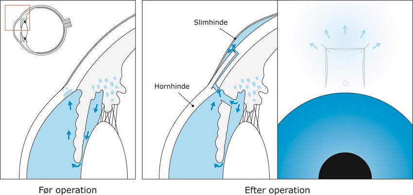 6-operation for glaukom-trabekulektomi.jpg
