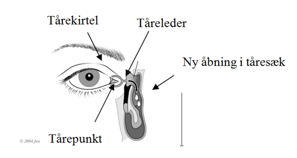 Tårevejsoperation - Dacryocystorhinostomi (DCR) - Aarhus ...