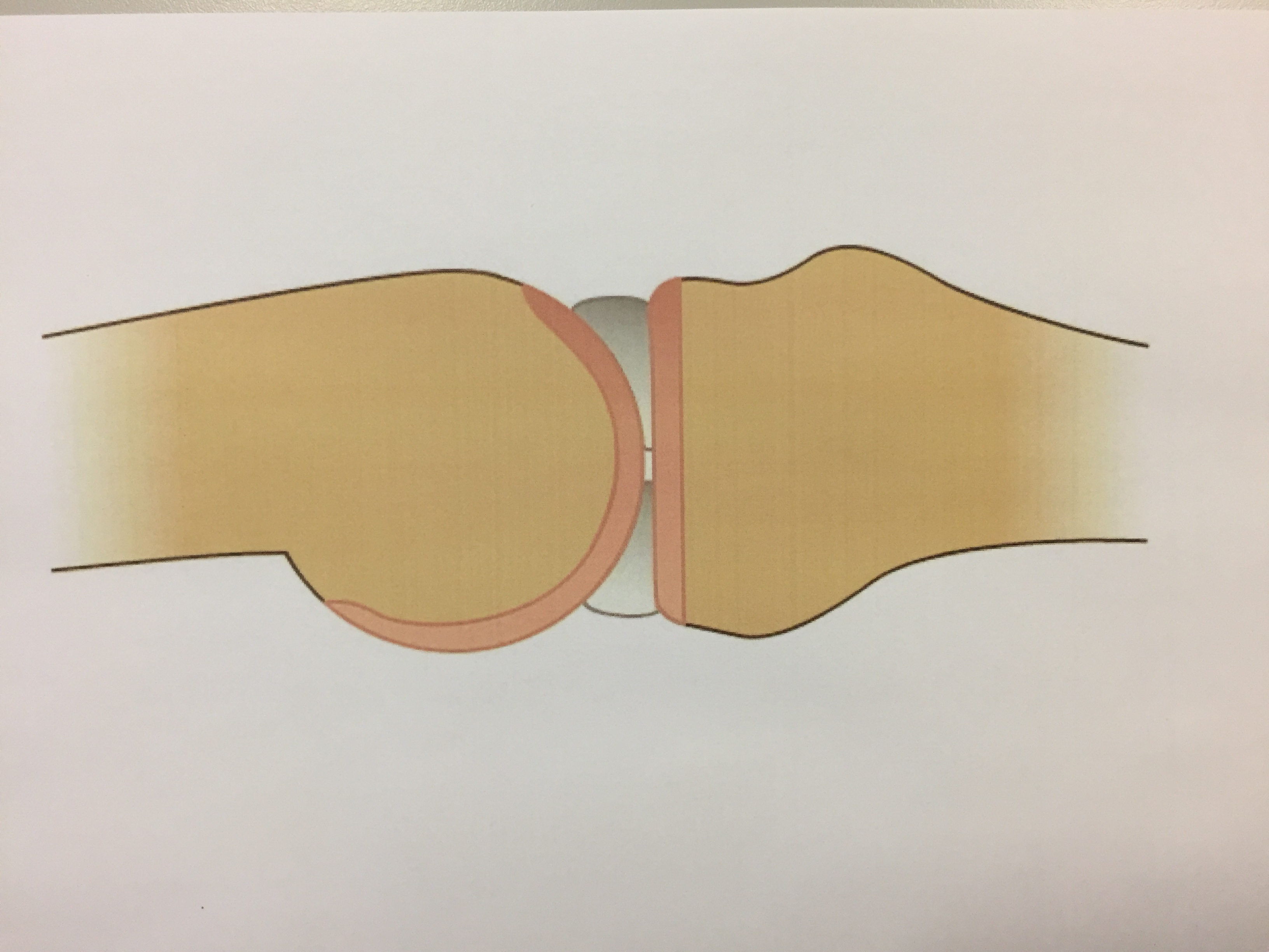 Marvcelletransplantation i knæet - Aarhus Universitetshospital