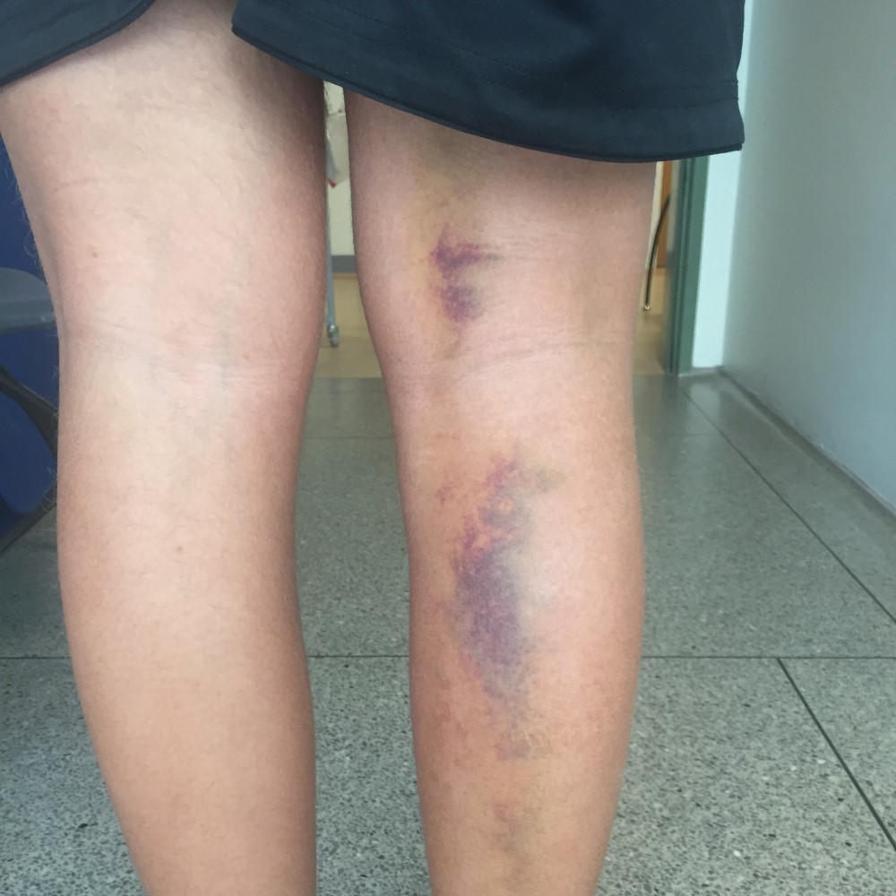 Løs knæskal: Efter operationen - Universitetshospital