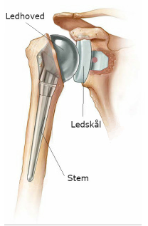 Hals usund konkurrerende Skulderprotese (kunstigt skulderled) - Aarhus Universitetshospital
