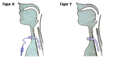 Trakeostomi efter operationen