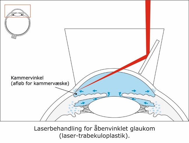 3- laserbehandling for glaukom - laser trabekuloplastik.jpg